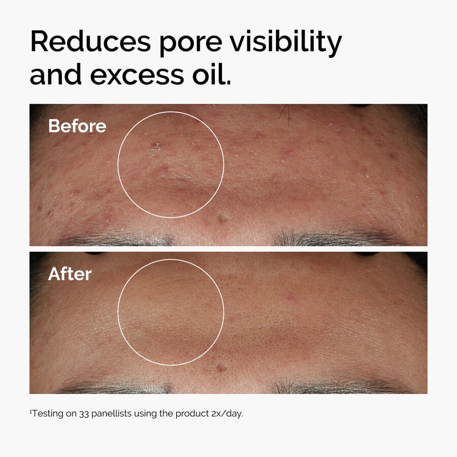 niacinamide-10-zinc-1-p6 ord-niacinamide-zinc-blemish-serum-before-after-pores.jpg