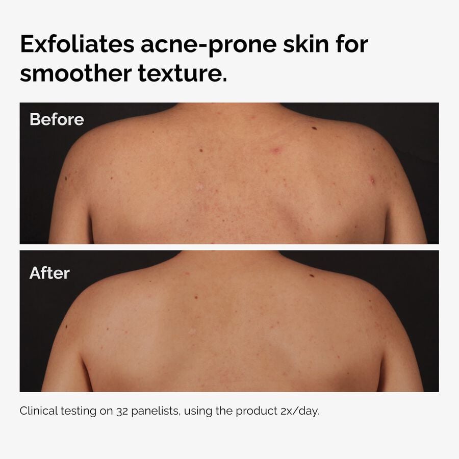 salicylic-acid-0-5-body-serum-z1 ord-salicylic-acid-body-serum-before-after-graphic-NA.jpg