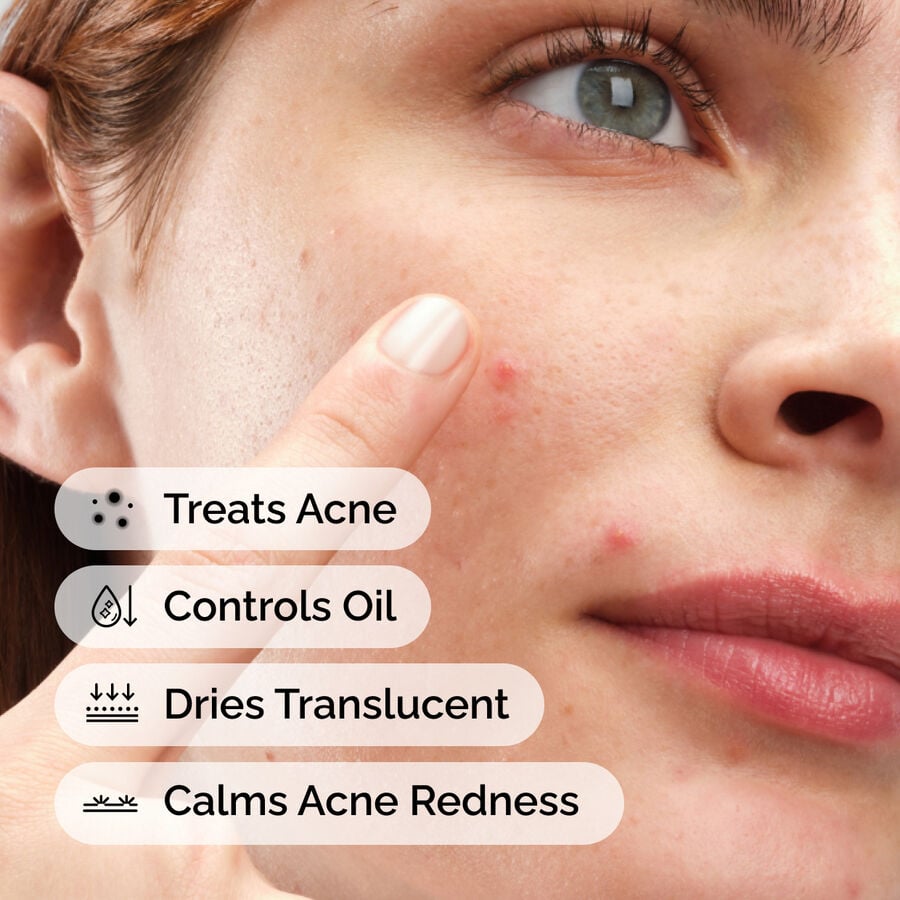 sulfur-10-powder-to-cream-concentrate-r2 ord-sulfur-10pct-powder-to-cream-concentrate-model-application-with-benefits-acne.jpg